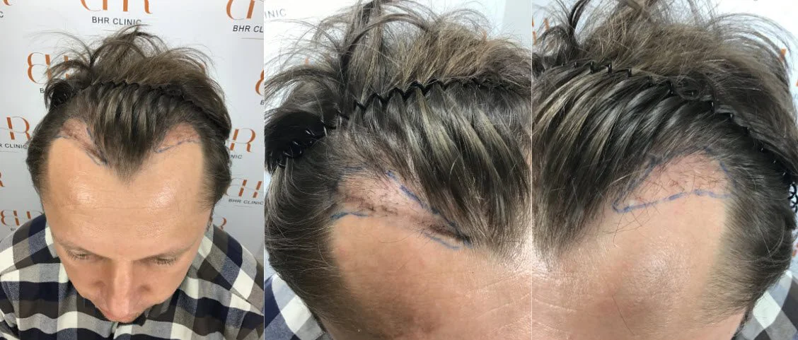 14 μήνες μετά την επιδιόρθωση μεταμόσχευσης μαλλιών